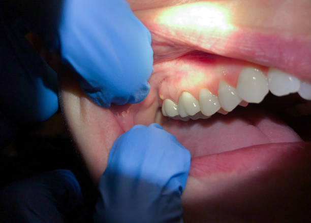Best Cracked Tooth Emergency Dentist  in Macarthur, WV